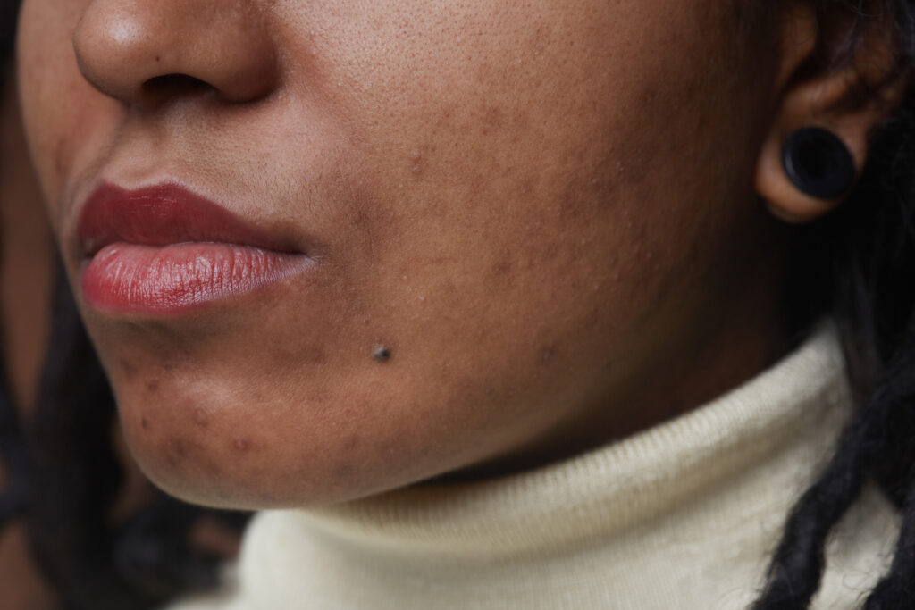 Melasma Hyperpigmentation in Mississauga - Expert Tips