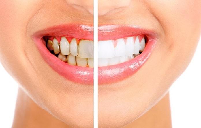 Teeth Whitening - Smile Care Dental Hospital