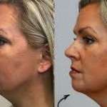 Under Eye Bag Filler Cost In Alameda County