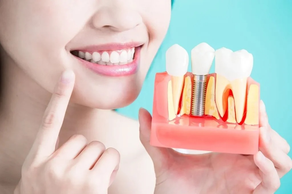 Best Dental Implants in Mississauga: 5 Key Benefits You Should Know – villagedentalOfstreetsville
