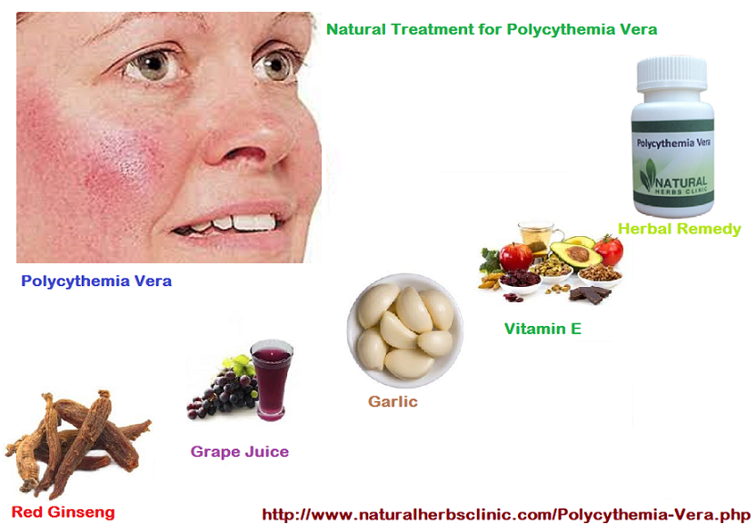 Herbal Remedies for Polycythemia Vera | Symptoms, Cause, Treatment - Natural Herbs Clinic