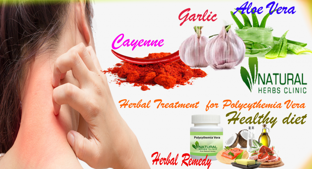 Natural and Herbal Treatment for Polycythemia Vera
