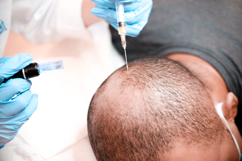 Transform Your Hair with PRP Hair Restoration: Insights from Vancouver Experts | by Enhancement Institute | Jun, 2025 | Medium