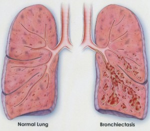 Bronchiectasis Relief can be found in Natural Treatment - Herbs Solutions By Nature Blog
