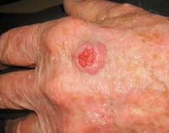 Top 10 Skin Bumps You Shouldn’t Ignore—And How Nature Might Help – Freelancer / Agency