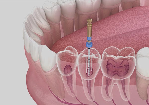 Root Canal Treatment in RR Nagar. If you’re experiencing severe tooth… | by Symphonysmiles | Jul, 2025 | Medium